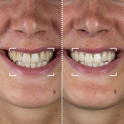 SMILYS LightTherapy™