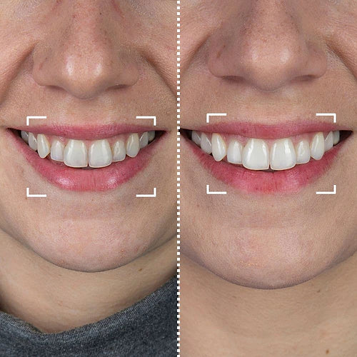 SMILYS LightTherapy™